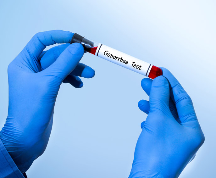 Gonorrhée Gonorrhée
